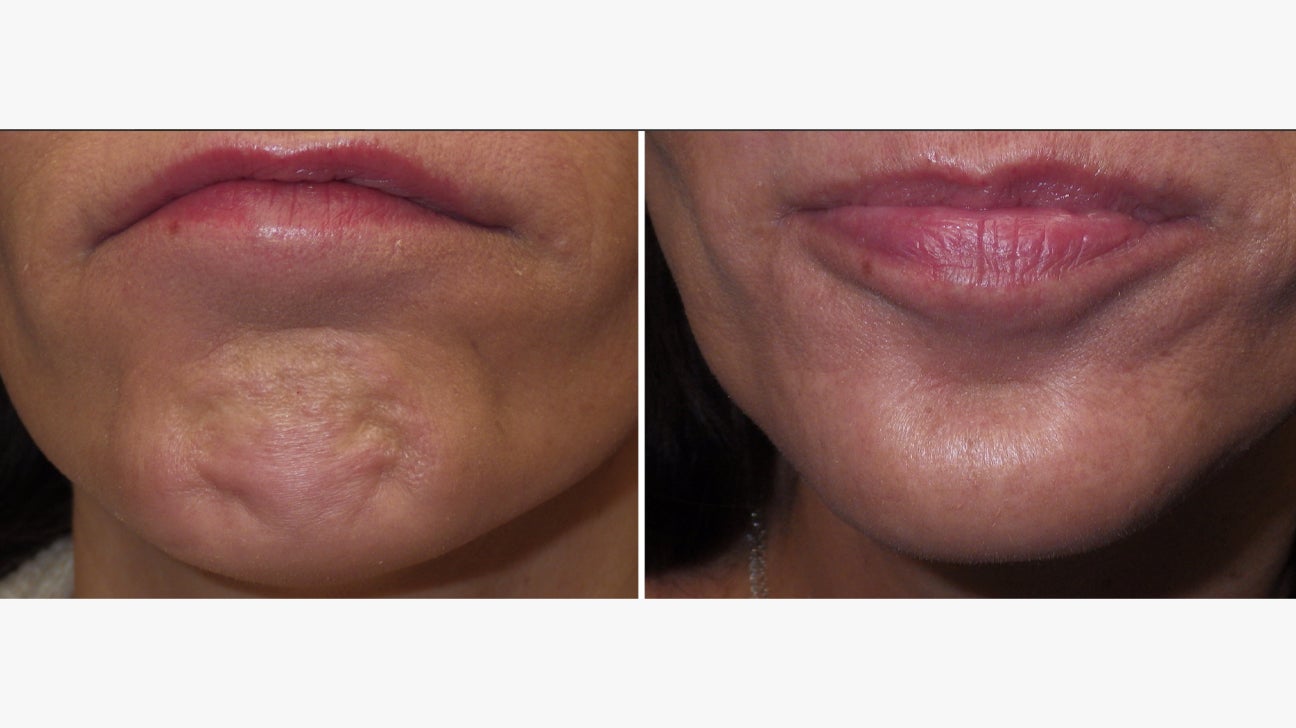 cleft chin removal before and after