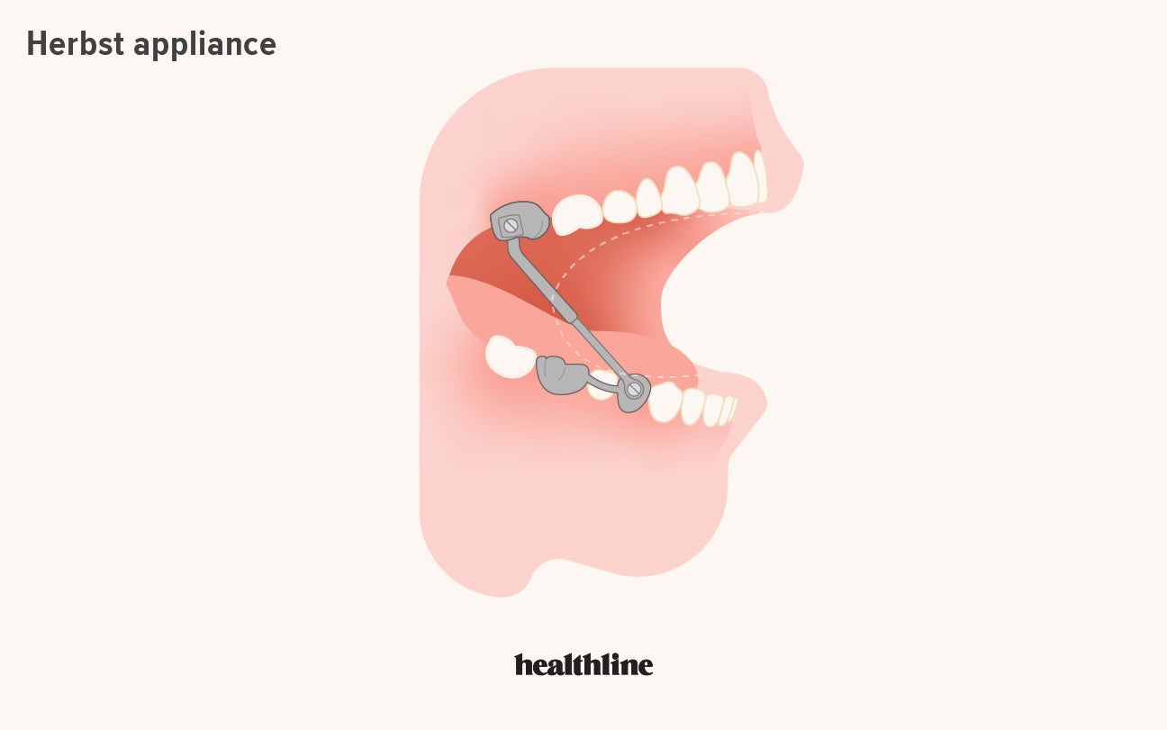 The Journey to Having Perfect, Straight Teeth!