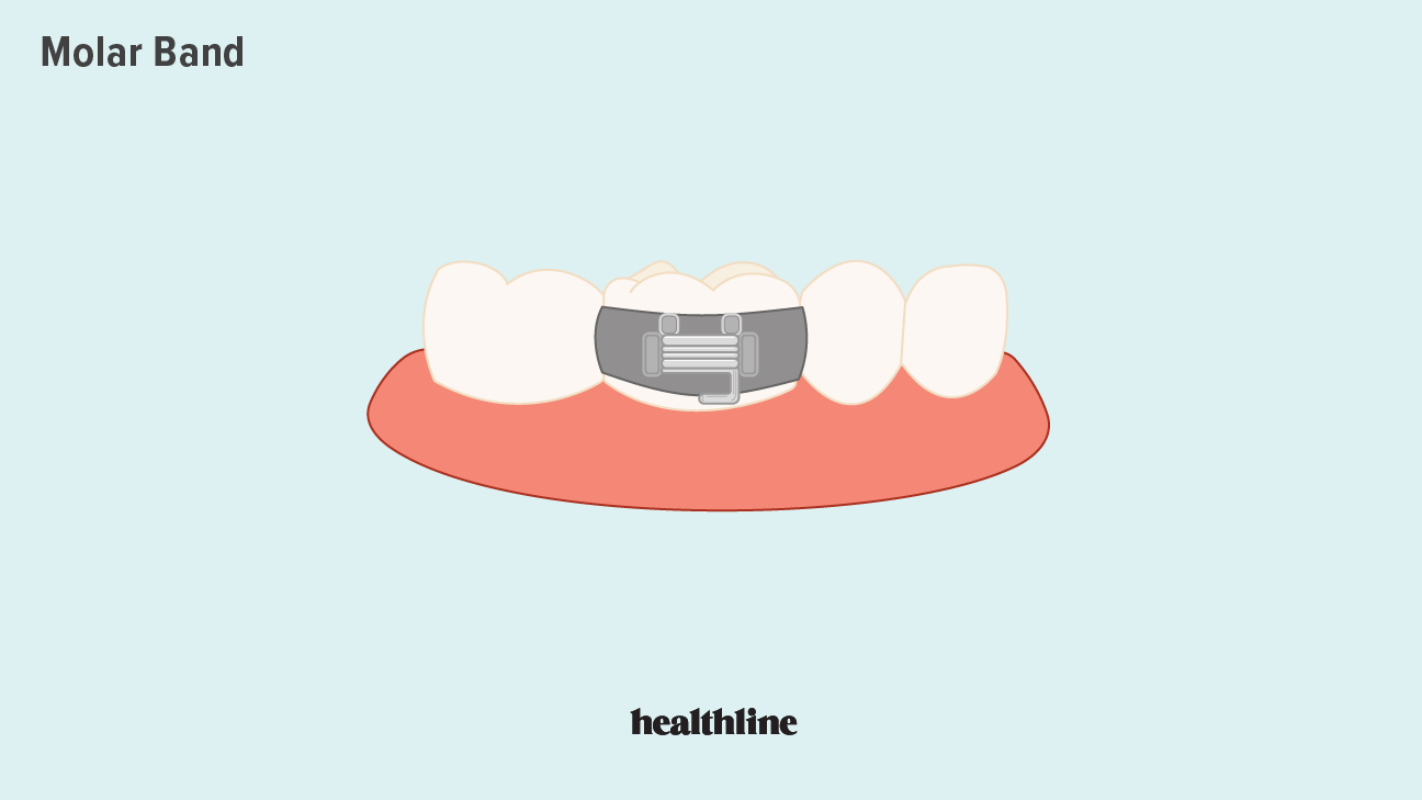 Molar Bands Use, Benefits and Pain Relief Healthy Lifestyle