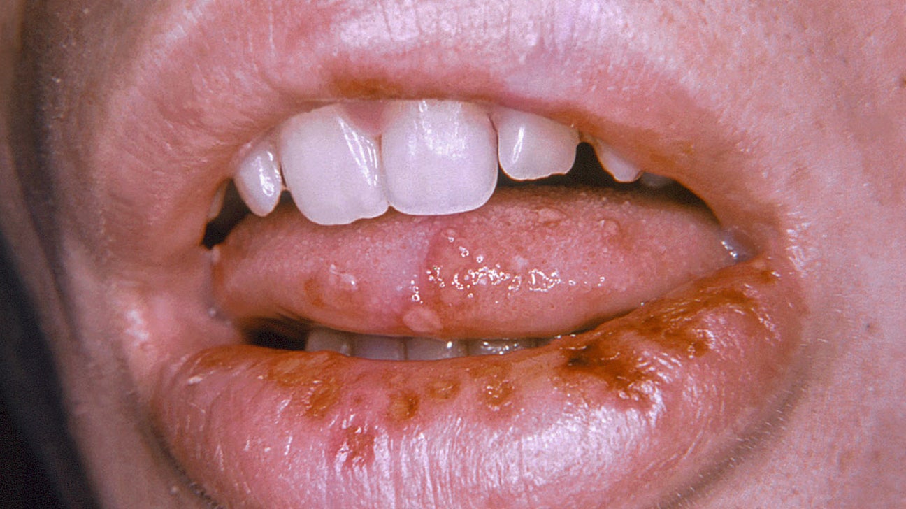 Stress herpes Herpes zoster: