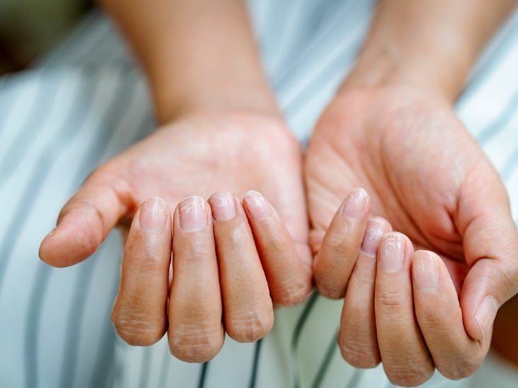 how to treat nail psoriasis nhs a fejbőr kezelése pikkelysömörből népi gyógymódokkal