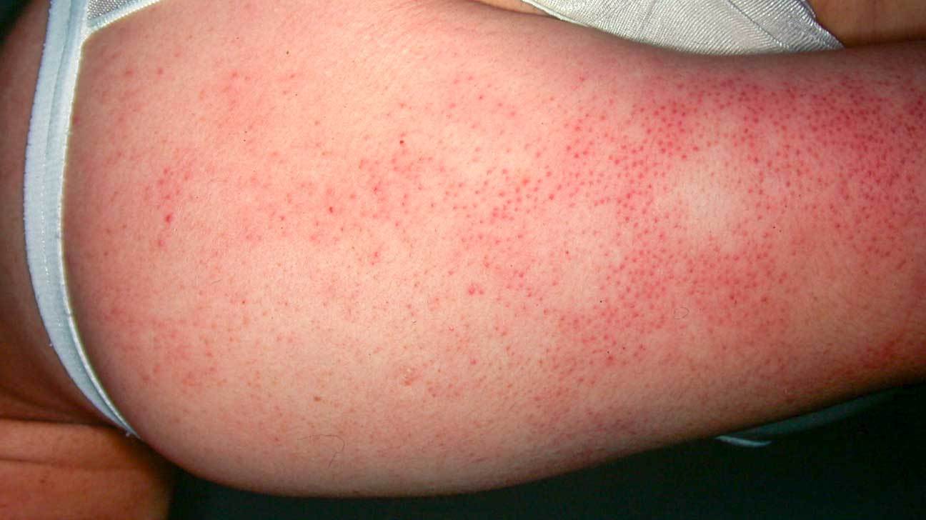 Keratosis Pilaris Chicken Skin Pictures Causes And Treatment