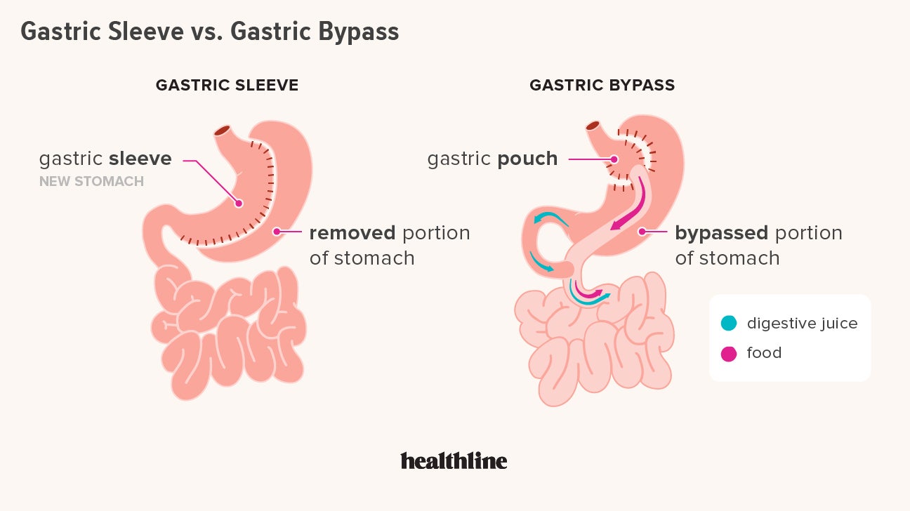 Bariatric Surgery : Types, Procedures, Benefits & Results