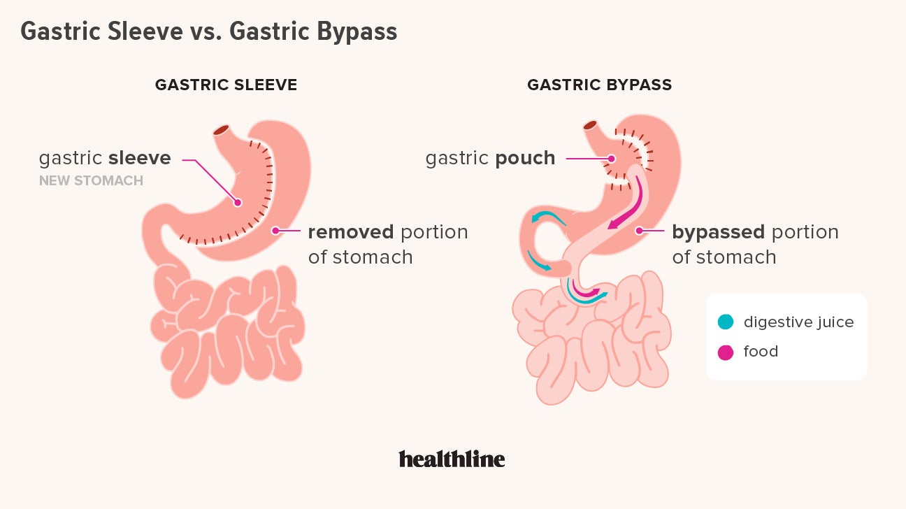 Gastric Bypass Before And After Body