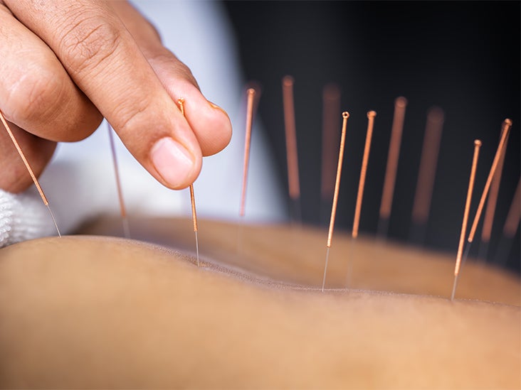 Acupuncture May Be Effective in Reducing Indigestion Symptoms