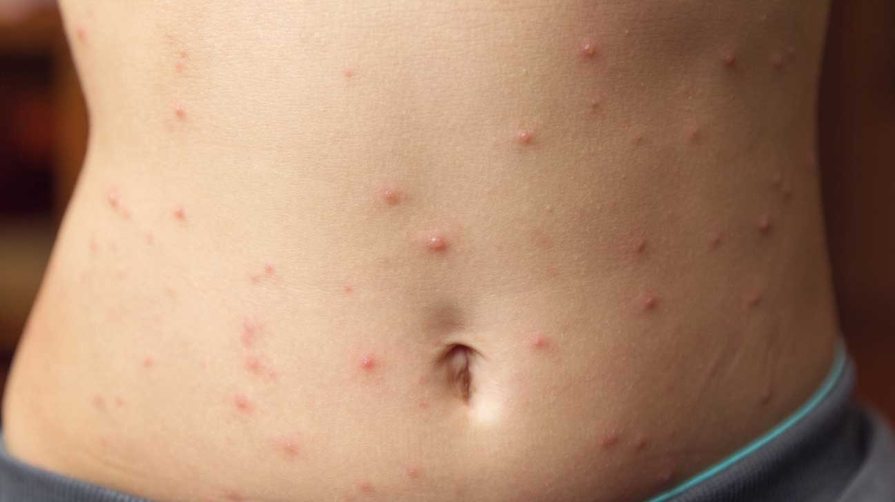 How to get rid of red spots from allergic reaction