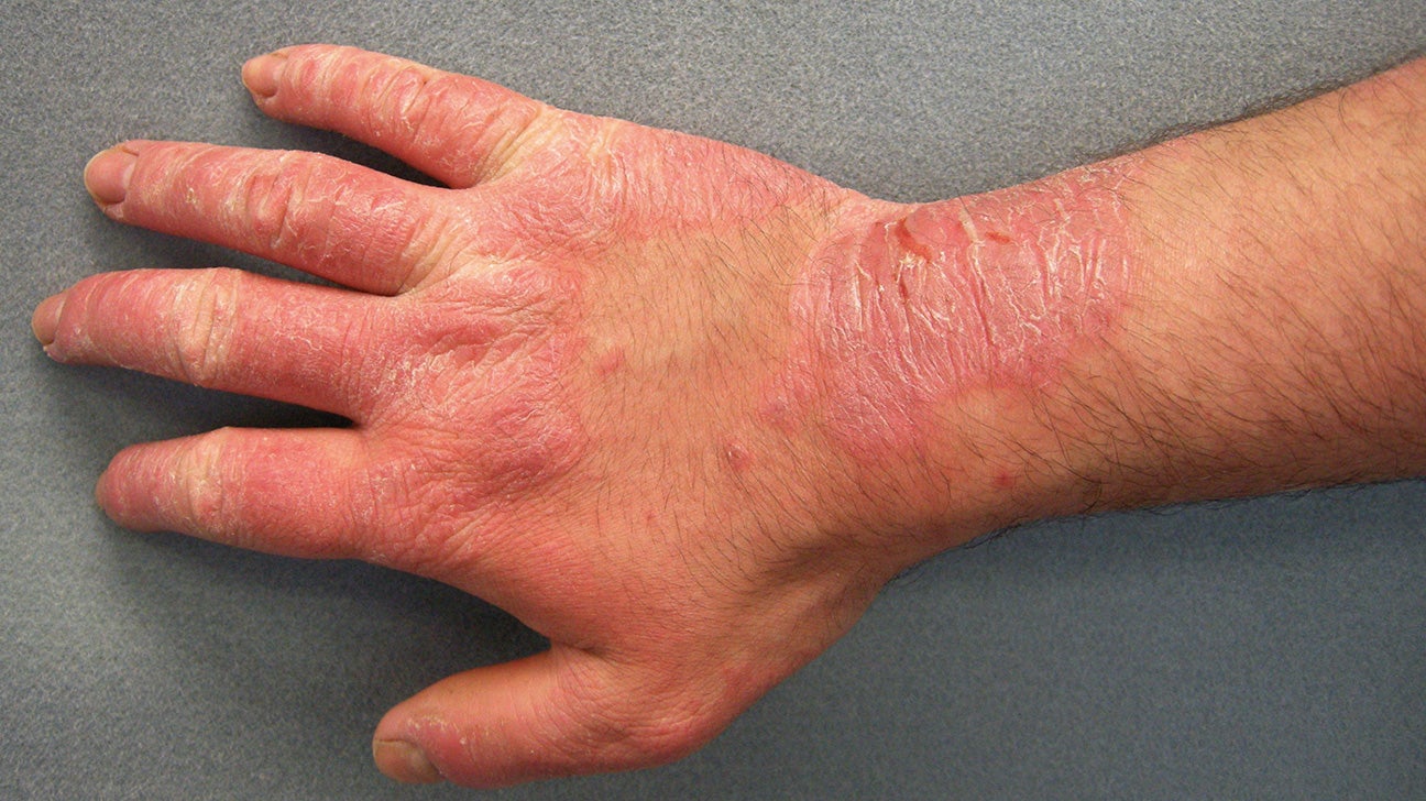 Allergic reaction to hands and feet