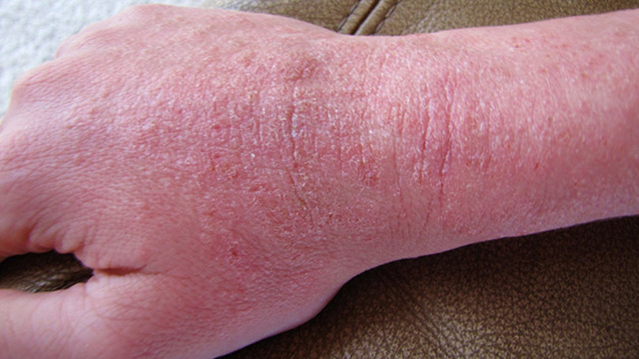 rash-22-common-skin-rashes-pictures-causes-and-treatment