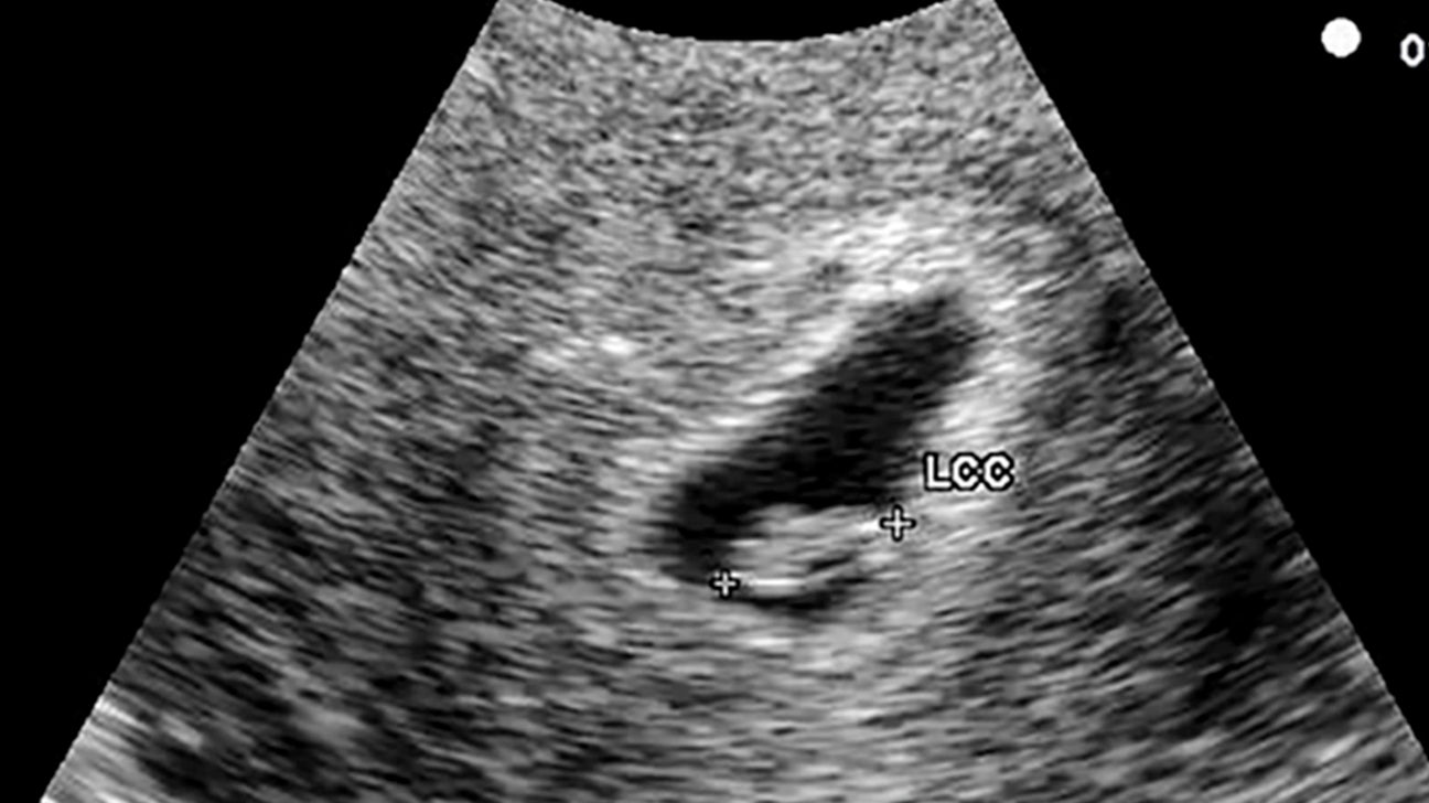 Week ultrasound 8 normal What you