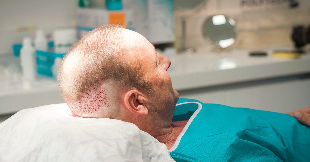 Can a Hair Transplant Be Done on Scar Tissue & Existing Scars?