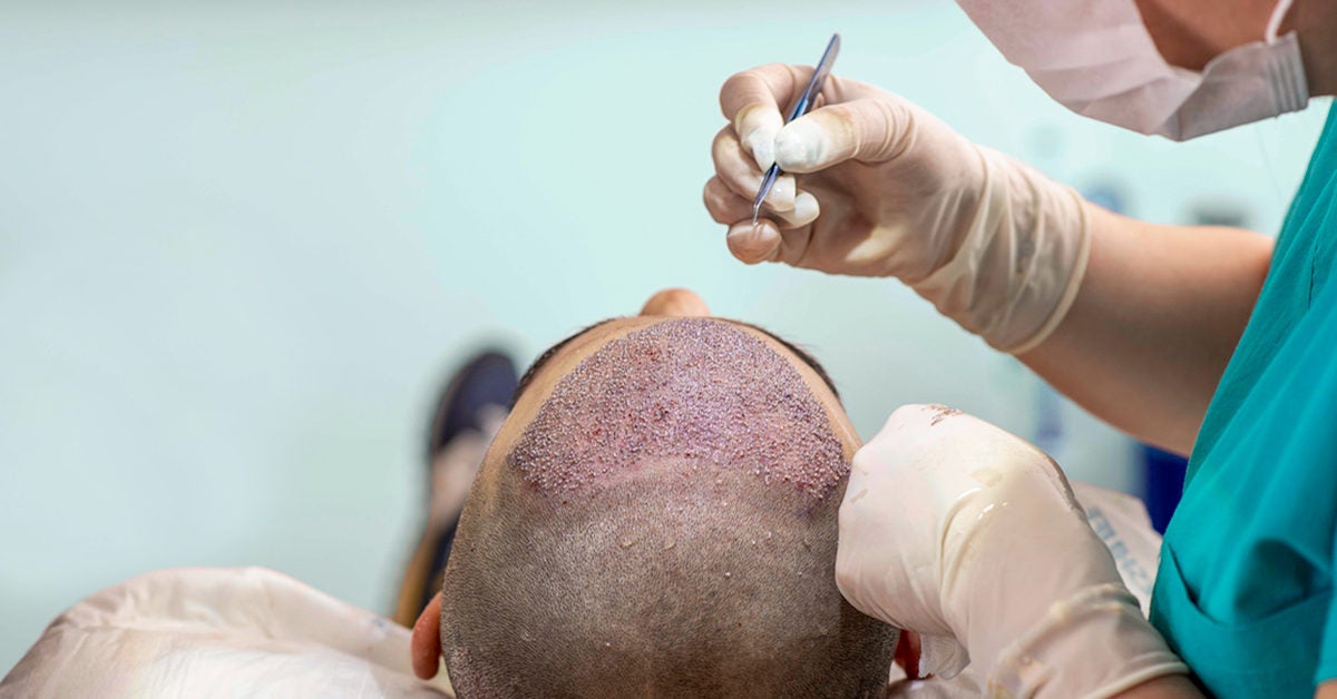 Hair Transplant Turkey - £1499 - MedAway UK