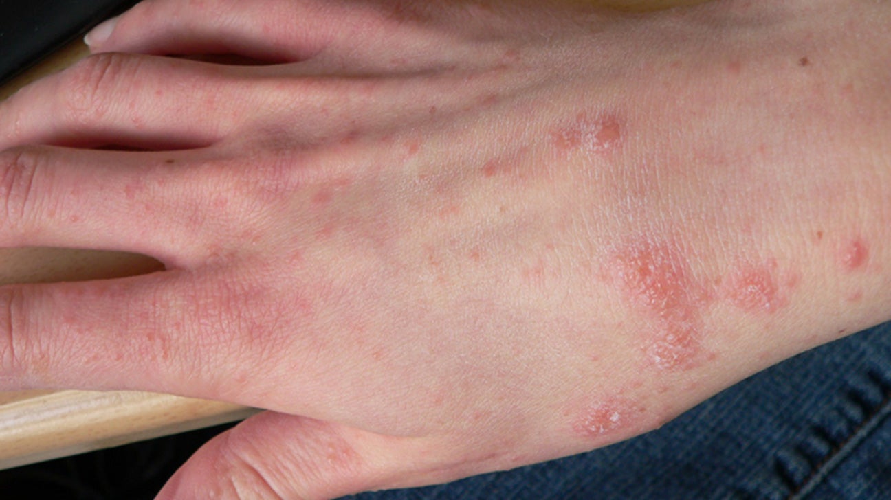 Allergic reaction bumps on fingers