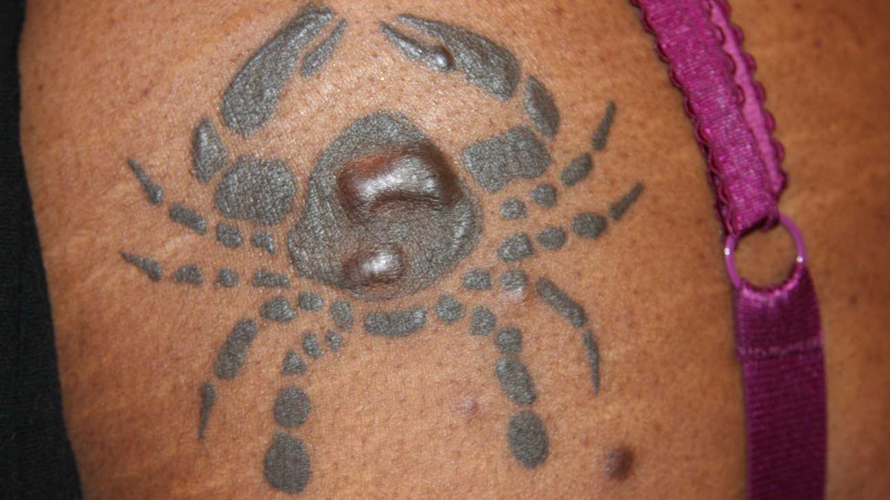 Tattoo Scab Bleeding Why It Happens and How To Prevent It  Saved Tattoo