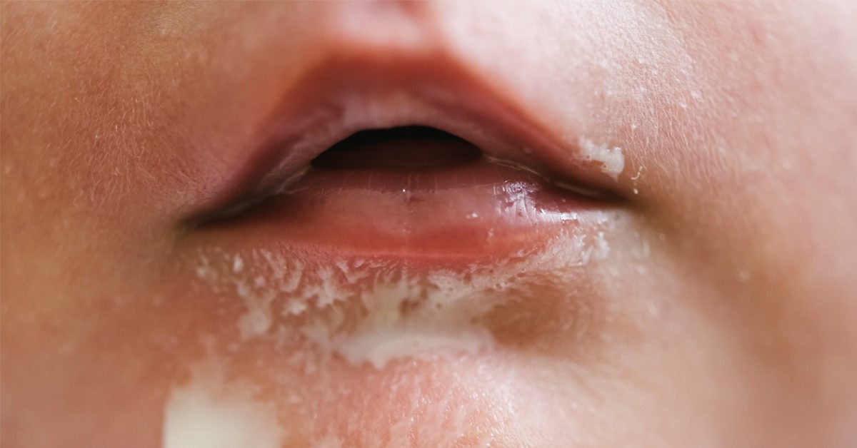 Baby Spitting Up Curdled Milk Causes and Treatments