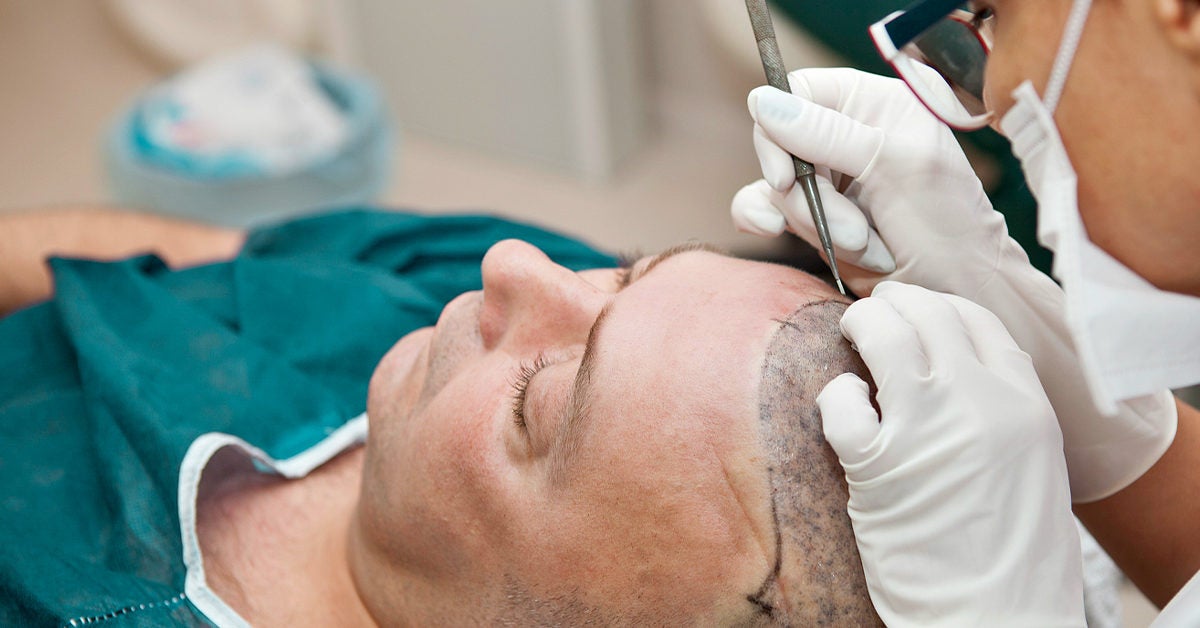 What are the topmost tips to choose the best hair transplant doctor? - Blog  - Profile Studios