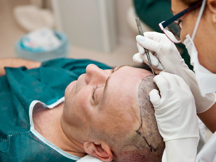 FUE Hair Transplant: What to Expect, Cost, Pictures, and More