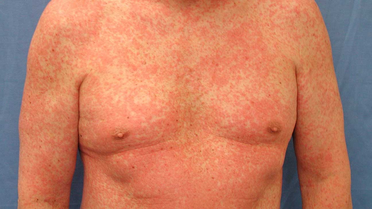 Rash 22 Common Skin Rashes Pictures Causes And Treatment