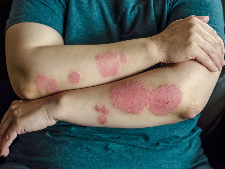 psoriasis skin disease spread)