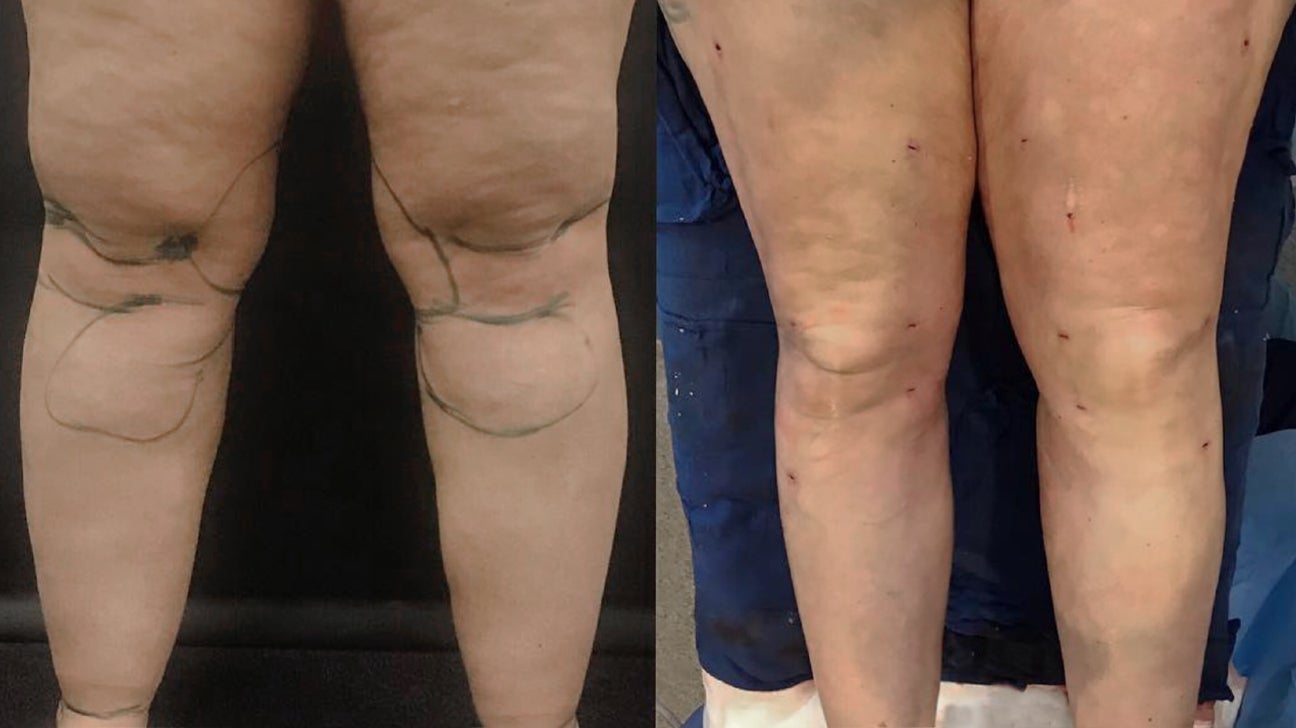 Knee Liposuction: Procedure, Recovery, Side Effects, Cost