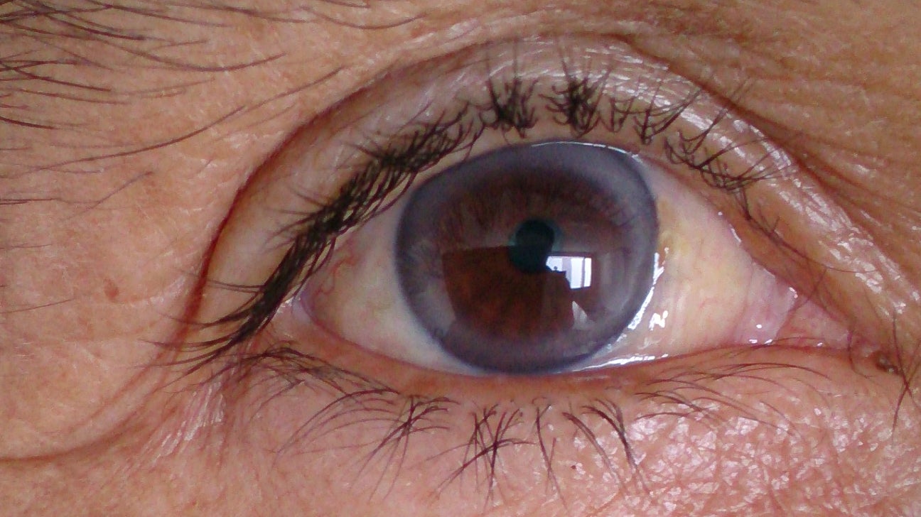 Blue Ring Around Eye: Pictures, Causes & Treatment