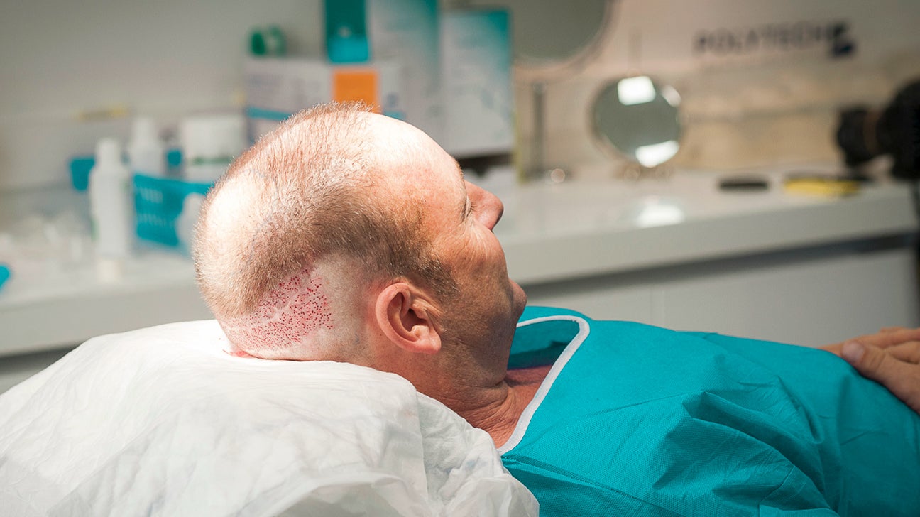 Hair Transplant on Scar Yes It Works, Here's How