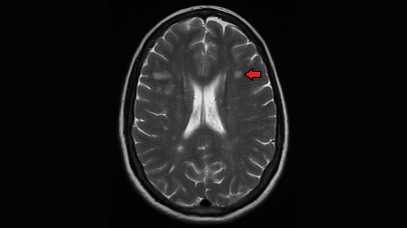 Ms Brain Lesions Vs Normal