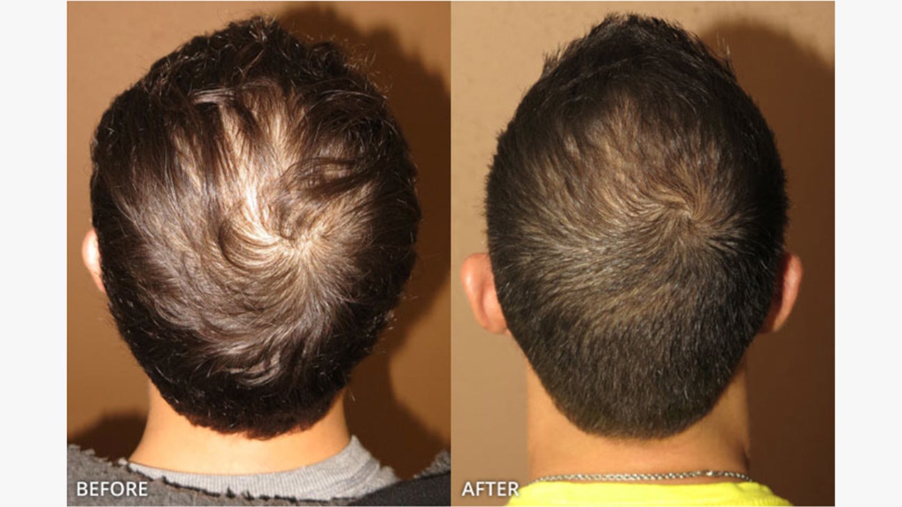 FUE Hair Transplant Sydney  Dr Jassim Daood