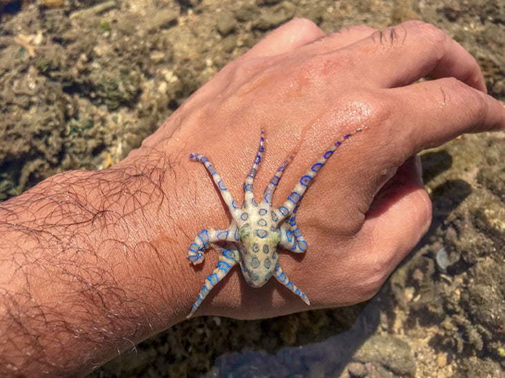 Blue-Ringed Octopus Bite Symptoms Emergency First Aid