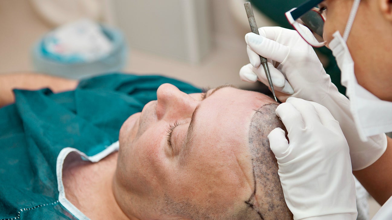 Is a Hair Transplant Permanent? What to Expect Long-Term