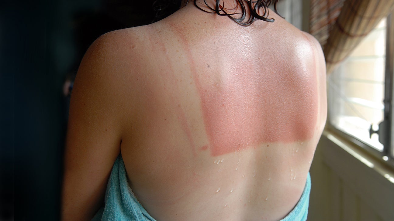 Keys to Sunburn Prevention: Symptoms, Causes & Remedies
