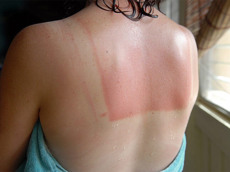 Sunburn Sun Tan Burn 732x549 Thumbnail 732x549 