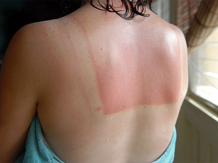 Does A Sunburn Turn Into A Tan What To Expect