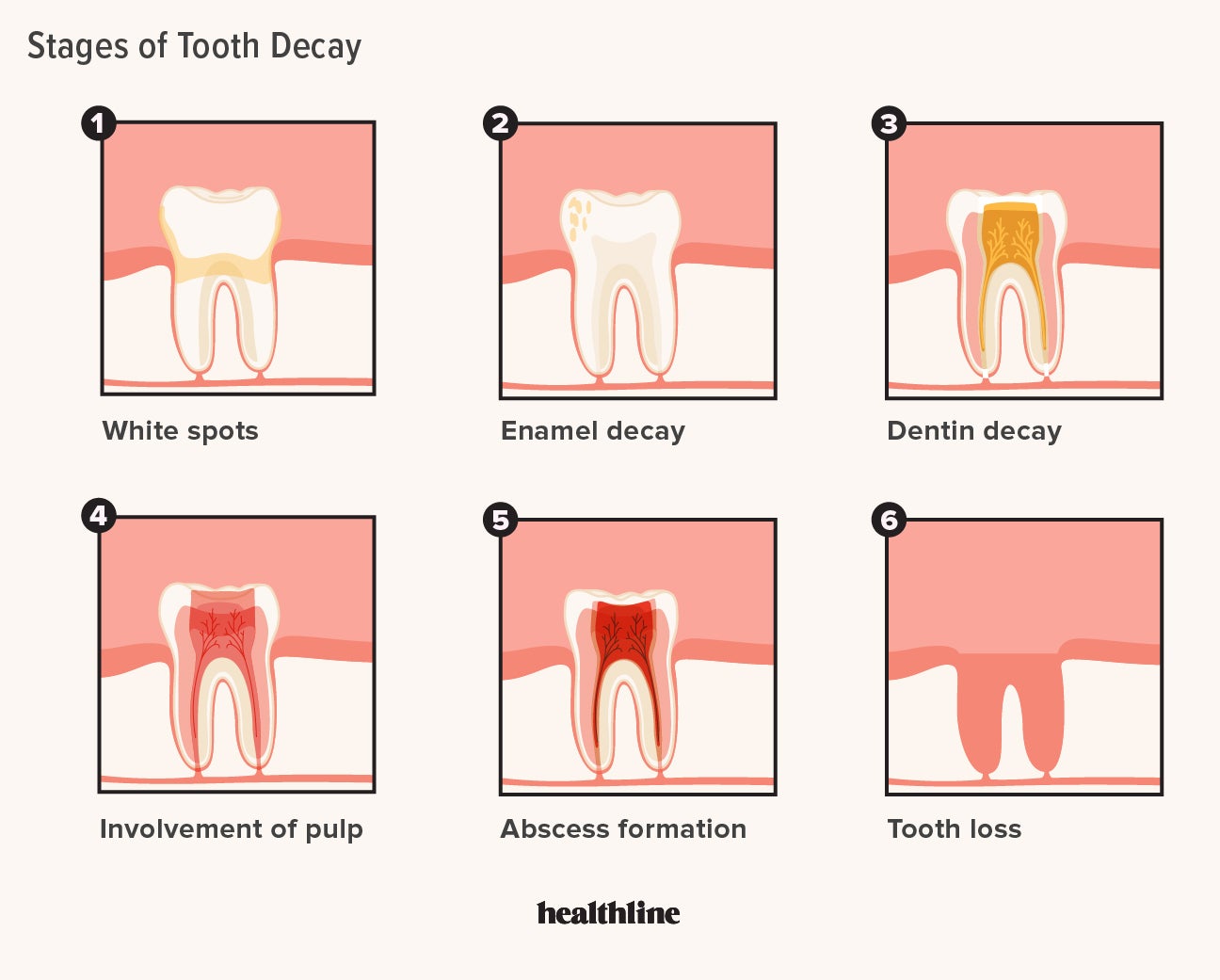 Tooth Decay Stages: 5 Stages and How to Treat Each