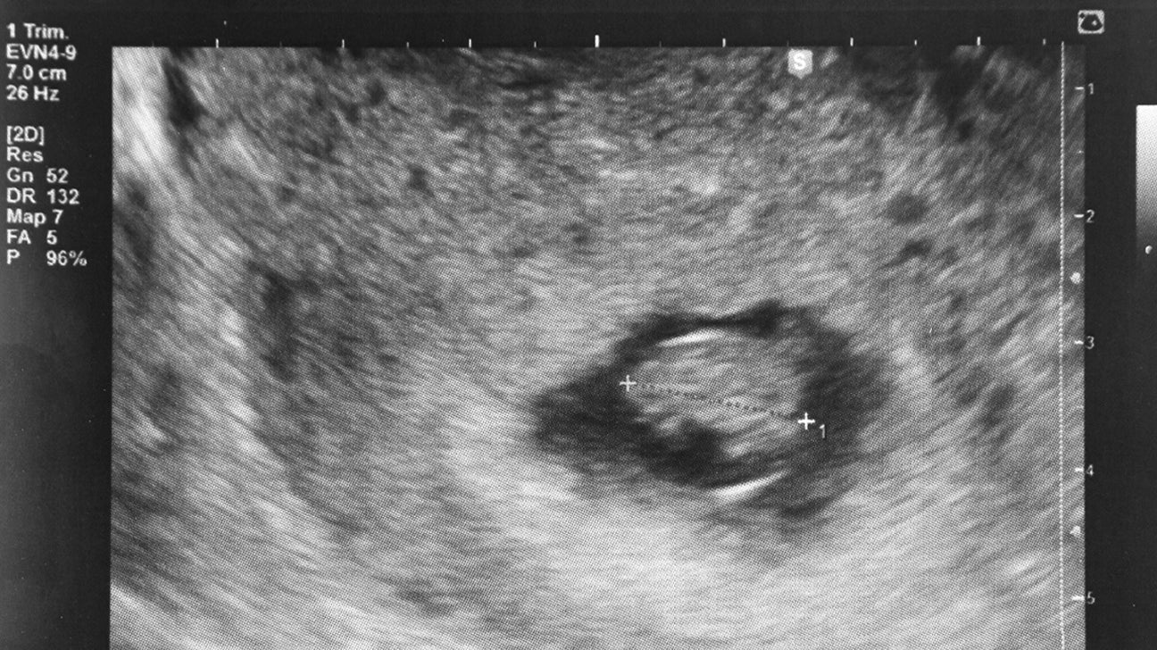 Tilted uterus ultrasound empty sac