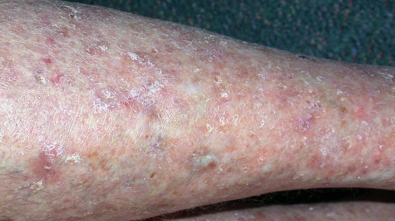 Red Spots on Legs: 7 Common Causes & What to Do - Tua Saúde