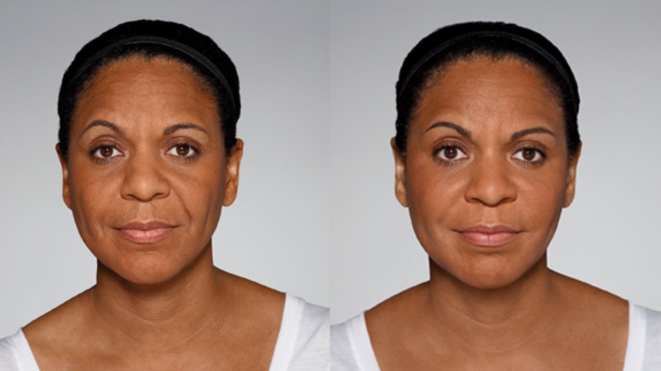 5pcs Nasolabial Folds Anti-Wrinkle Facial Lifting Facial Laugh Lines Care Patches