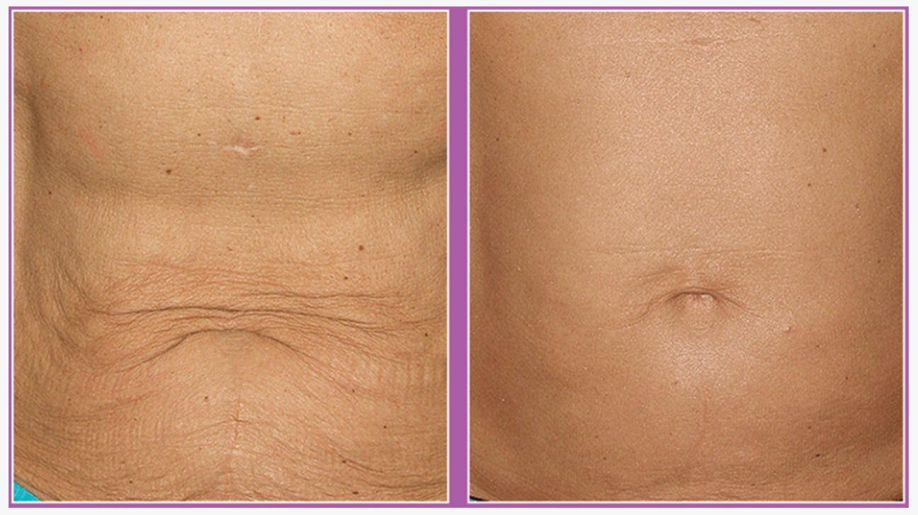 How Laser Skin Tightening Works - Radiofrequency Skin Treatment Details