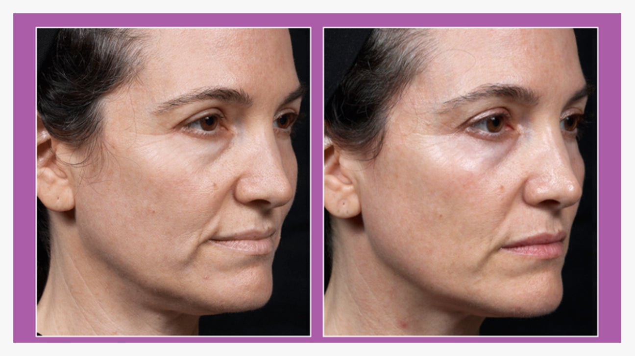 Does Radio Frequency Skin Tightening Work Benefits And Side Effects