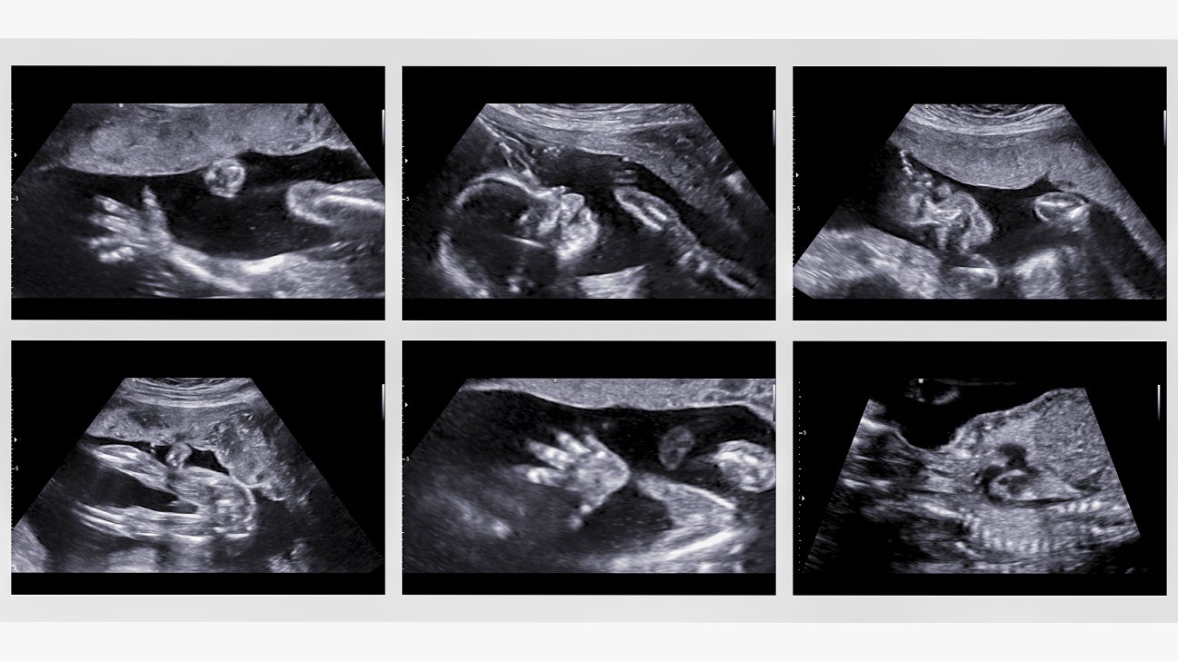 20 Week Ultrasound Everything You Want to Know