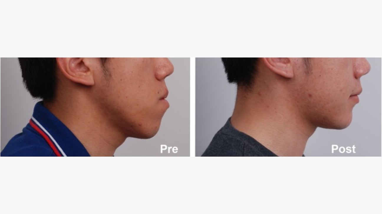 chin surgery