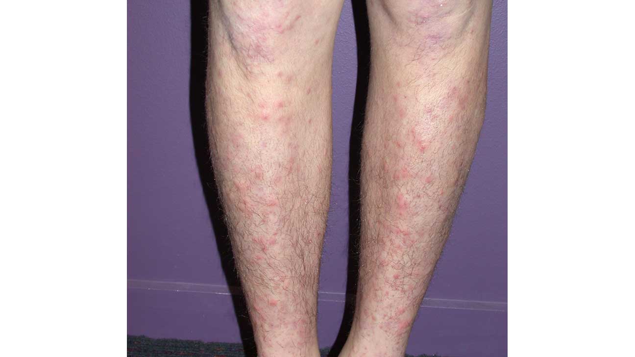 red spots lower legs