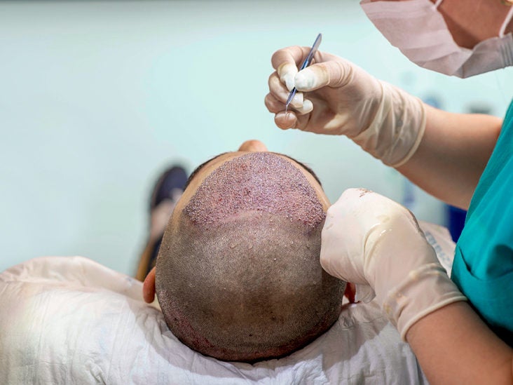 average cost of hair transplant surgery