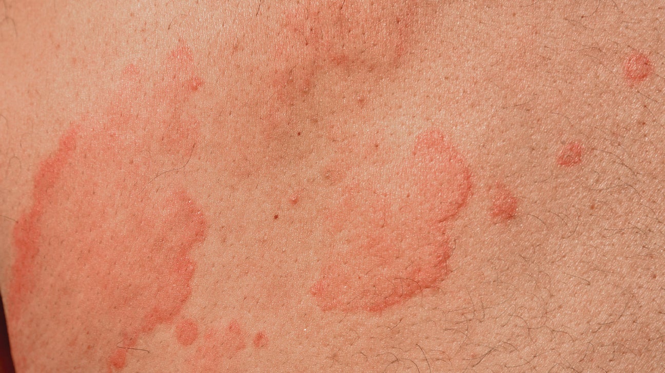 flat hives causes