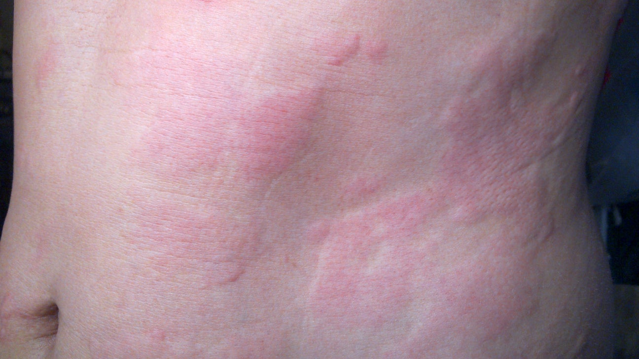 Awful heat rash in stomach fold now weeping - warning - photo