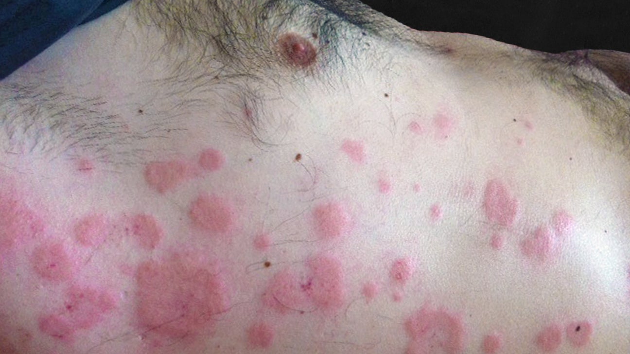 flat hives causes vörös napfoltok a bőrön viszketnek