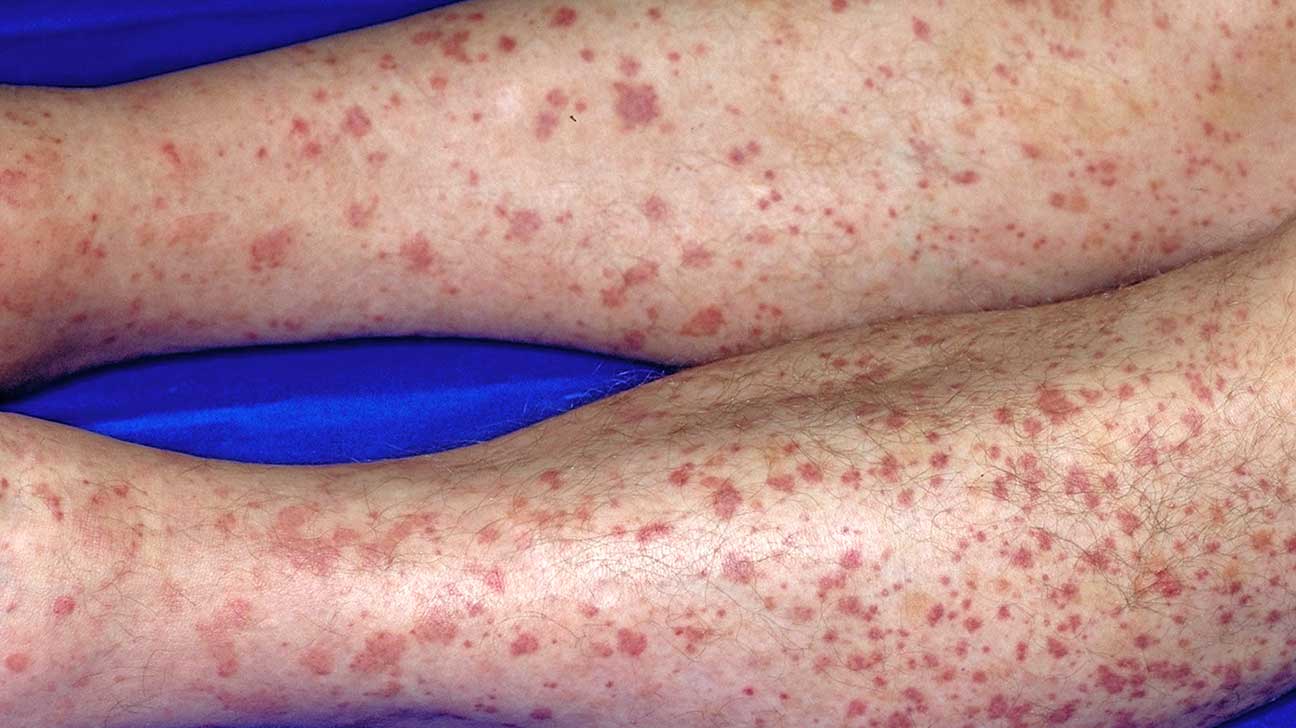 Vari t Restreindre Une Fois Que Little Red Spots On Legs Serviteur 