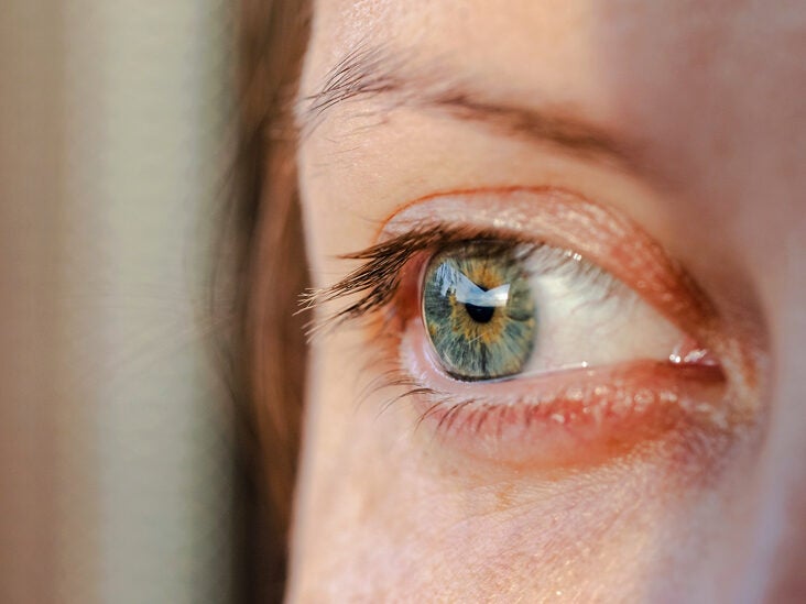 Dry Eyes Symptoms Treatment Causes And More