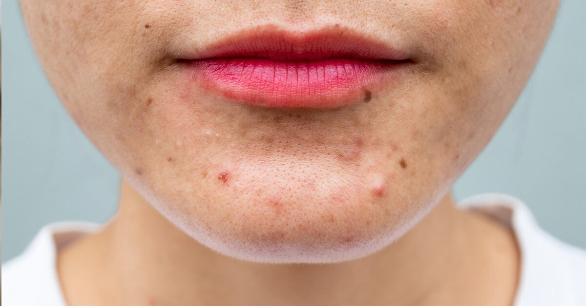 Postpartum Acne: Causes and Treatments That Work