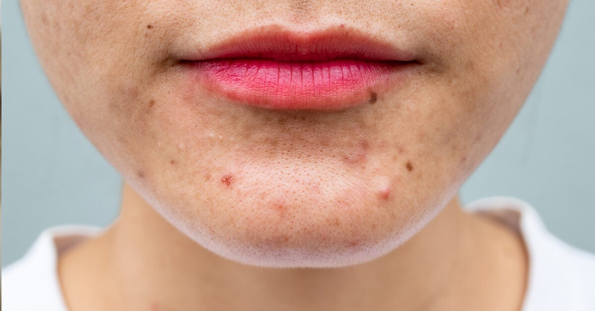 cold-sore-vs-pimple-causes-symptoms-and-treatment