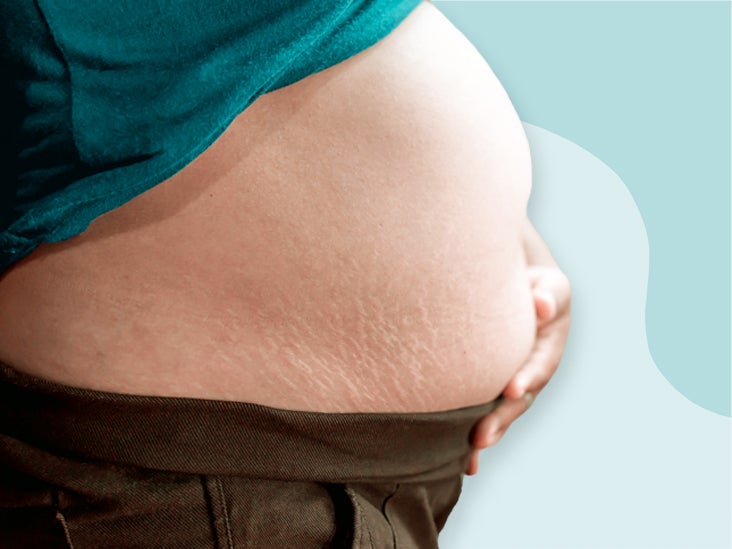 What Is A B Belly During Pregnancy And Why Does It Happen